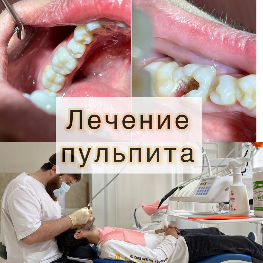 Лечение пульпита